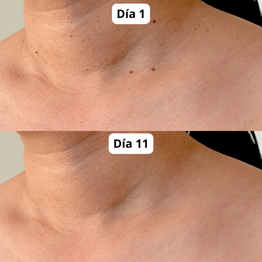 DermaPlus Kit - Removedor de Verrugas y Marcas de Piel