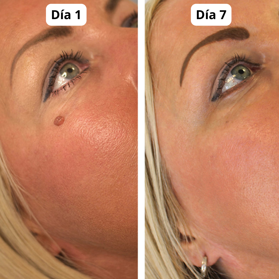 DermaPlus Kit - Removedor de Verrugas y Marcas de Piel
